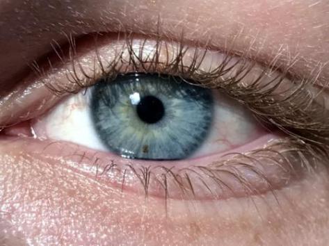 miosis-or-pinpoint-pupil-image-credit-lucashawranke-2018-february-11th